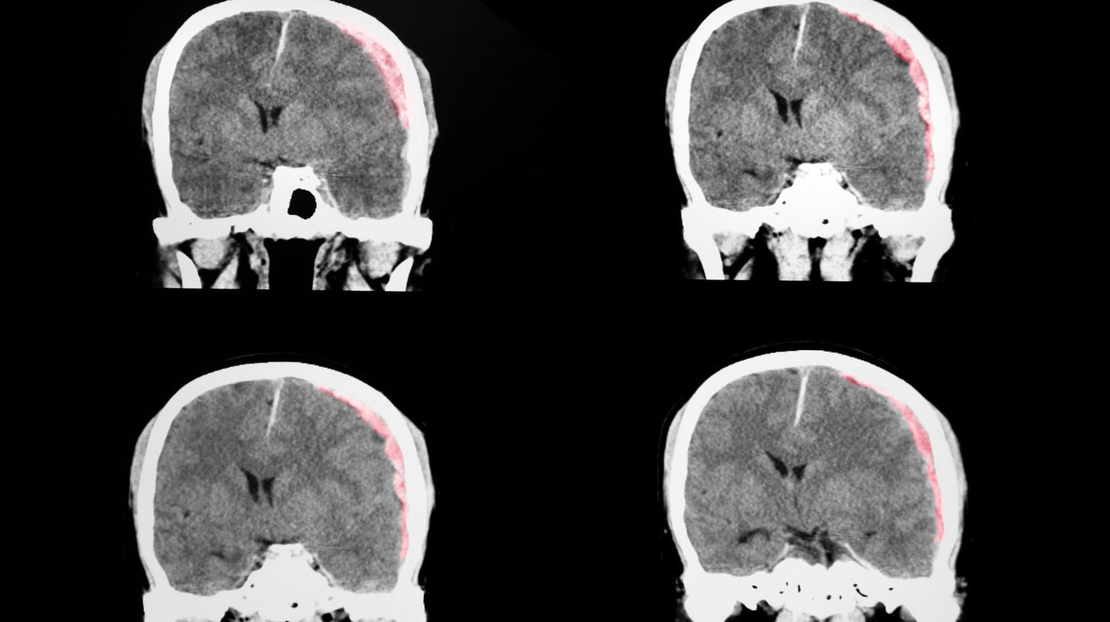 Best Neuro Rehabilitation for Traumatic Brain Injury